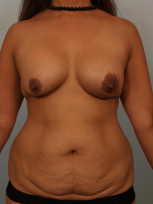 Mommy Makeover Before Photo | Phoenix and Scottsdale, AZ | Scottsdale Center for Plastic Surgery
