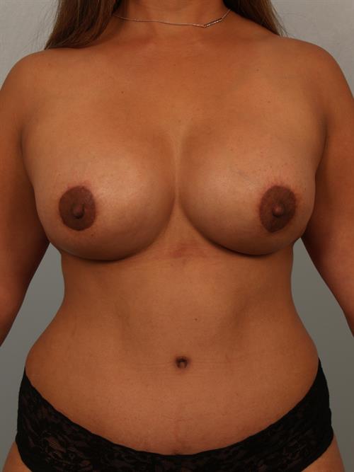 Revision Breast Surgery After Photo | ,  | 