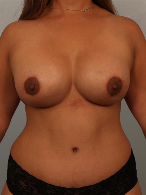 Mommy Makeover After Photo | Phoenix and Scottsdale, AZ | Scottsdale Center for Plastic Surgery