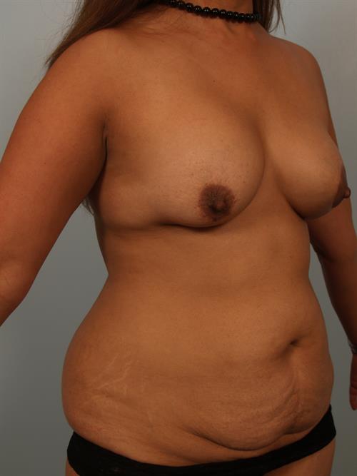 Mommy Makeover Before Photo | Phoenix and Scottsdale, AZ | Scottsdale Center for Plastic Surgery