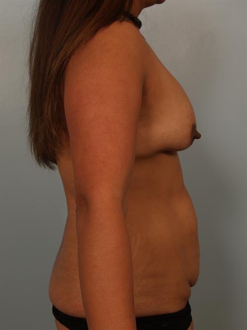 Mommy Makeover Before Photo | Phoenix and Scottsdale, AZ | Scottsdale Center for Plastic Surgery
