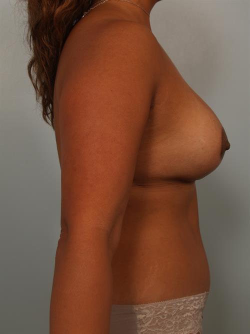 Mommy Makeover After Photo | Phoenix and Scottsdale, AZ | Scottsdale Center for Plastic Surgery