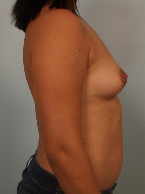 Tuberous Breast Surgery Before Photo | Phoenix and Scottsdale, AZ | Scottsdale Center for Plastic Surgery