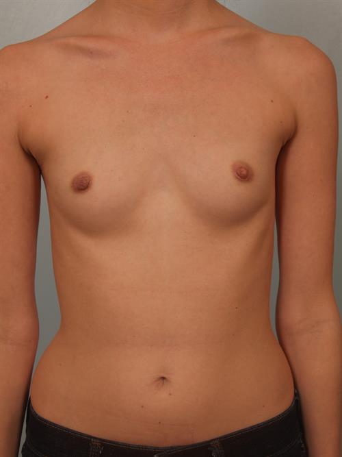 Breast Augmentation Before Photo | Phoenix and Scottsdale, AZ | Scottsdale Center for Plastic Surgery