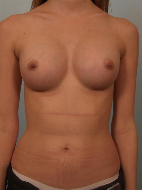 Breast Augmentation After Photo | Phoenix and Scottsdale, AZ | Scottsdale Center for Plastic Surgery