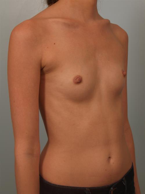 Breast Augmentation Before Photo | Phoenix and Scottsdale, AZ | Scottsdale Center for Plastic Surgery