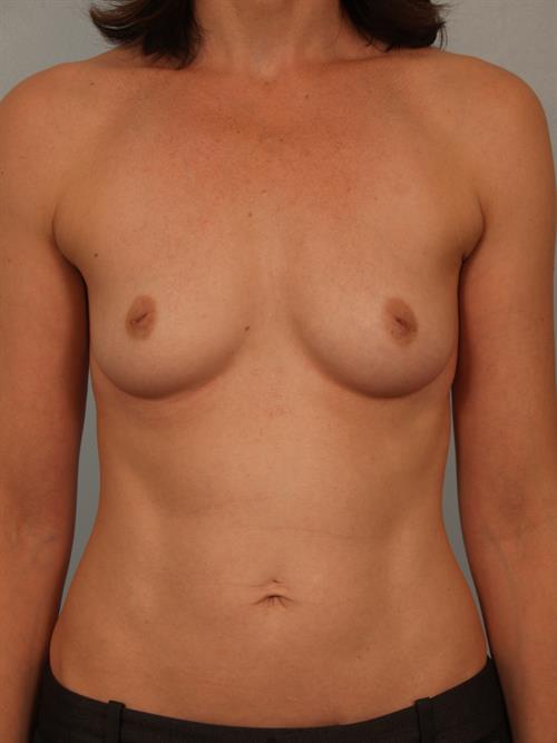 Breast Augmentation Before Photo | Phoenix and Scottsdale, AZ | Scottsdale Center for Plastic Surgery