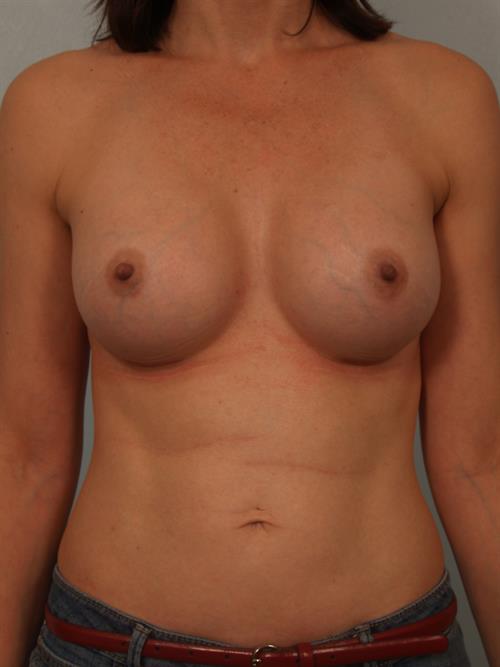 Breast Augmentation After Photo | Phoenix and Scottsdale, AZ | Scottsdale Center for Plastic Surgery