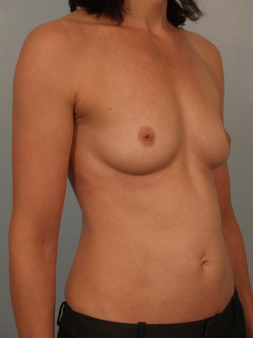Breast Augmentation Before Photo | Phoenix and Scottsdale, AZ | Scottsdale Center for Plastic Surgery
