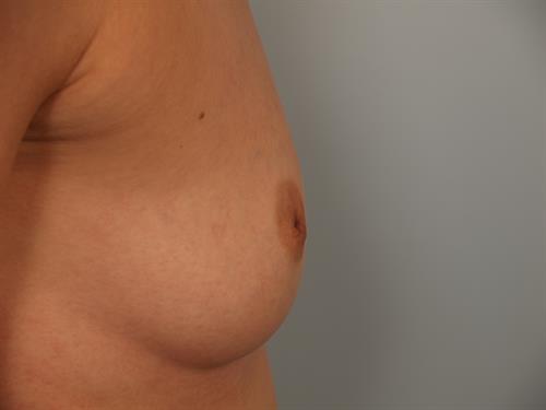 Breast Augmentation Before Photo | Phoenix and Scottsdale, AZ | Scottsdale Center for Plastic Surgery