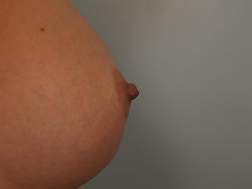 Breast Augmentation After Photo | Phoenix and Scottsdale, AZ | Scottsdale Center for Plastic Surgery