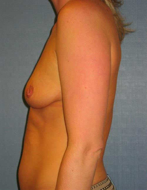Nipple/Areolar Surgery Before Photo | Phoenix and Scottsdale, AZ | Scottsdale Center for Plastic Surgery