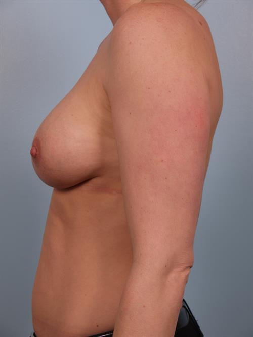 Nipple/Areolar Surgery After Photo | Phoenix and Scottsdale, AZ | Scottsdale Center for Plastic Surgery