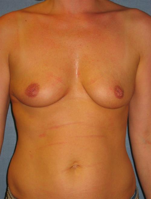 Nipple/Areolar Surgery Before Photo | Phoenix and Scottsdale, AZ | Scottsdale Center for Plastic Surgery