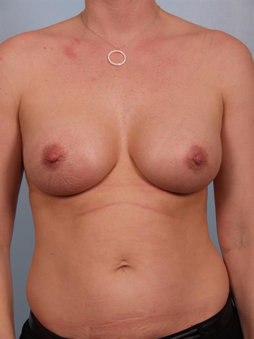 Nipple/Areolar Surgery After Photo | Phoenix and Scottsdale, AZ | Scottsdale Center for Plastic Surgery