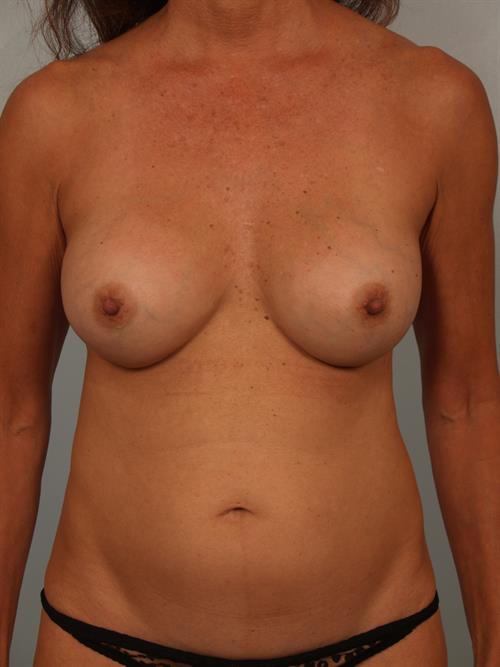 Mommy Makeover Before Photo | Phoenix and Scottsdale, AZ | Scottsdale Center for Plastic Surgery