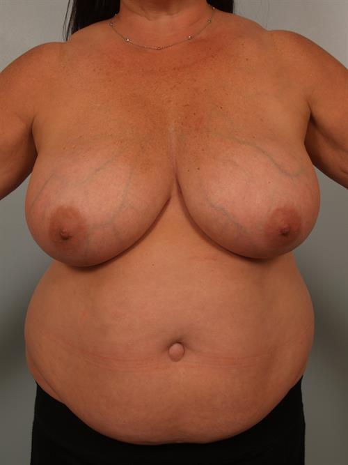 Breast Reduction Before Photo | Phoenix and Scottsdale, AZ | Scottsdale Center for Plastic Surgery