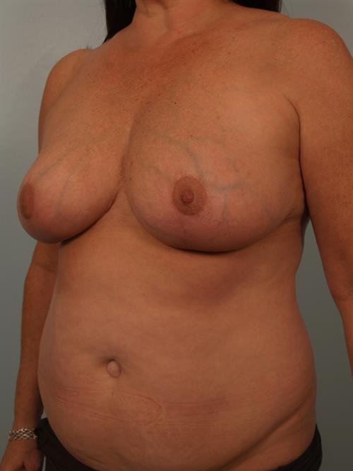 Breast Reduction After Photo | Phoenix and Scottsdale, AZ | Scottsdale Center for Plastic Surgery