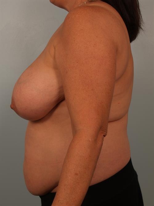 Breast Reduction Before Photo | Phoenix and Scottsdale, AZ | Scottsdale Center for Plastic Surgery