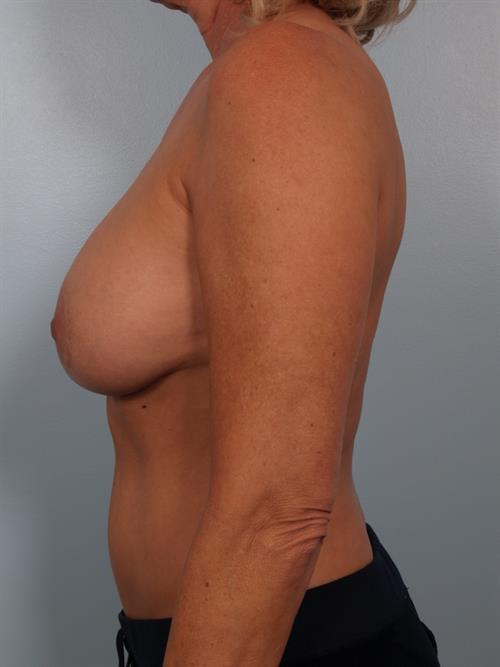 Revision Breast Surgery Before Photo | Phoenix and Scottsdale, AZ | Scottsdale Center for Plastic Surgery