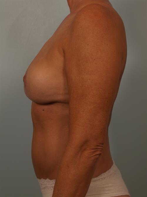 Revision Breast Surgery After Photo | Phoenix and Scottsdale, AZ | Scottsdale Center for Plastic Surgery