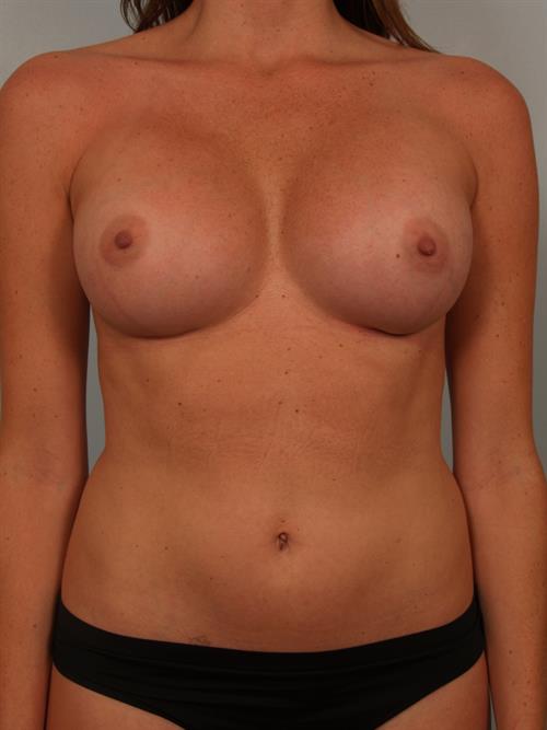 Breast Augmentation After Photo | Phoenix and Scottsdale, AZ | Scottsdale Center for Plastic Surgery