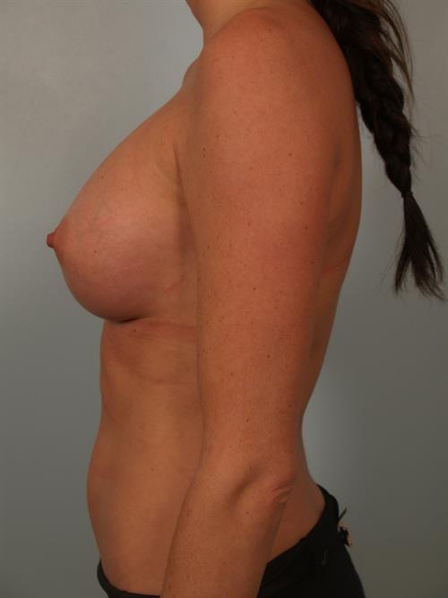 Breast Augmentation After Photo | Phoenix and Scottsdale, AZ | Scottsdale Center for Plastic Surgery