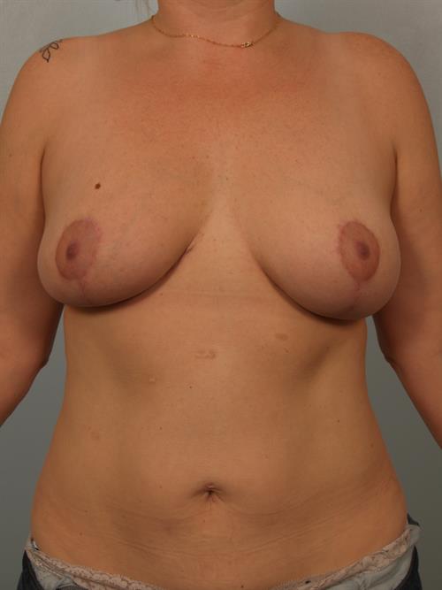 Breast Reduction After Photo | Phoenix and Scottsdale, AZ | Scottsdale Center for Plastic Surgery