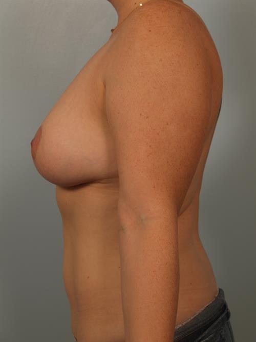 Breast Reduction After Photo | Phoenix and Scottsdale, AZ | Scottsdale Center for Plastic Surgery