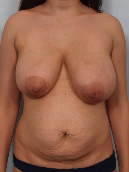 Breast Reduction Before Photo | ,  | 