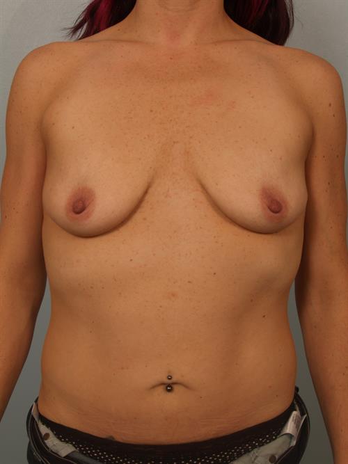 Breast Lift (Mastopexy) Before Photo | Phoenix and Scottsdale, AZ | Scottsdale Center for Plastic Surgery