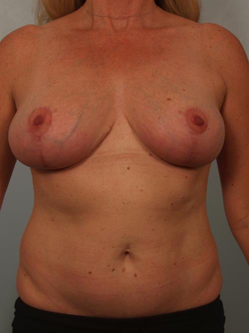 Breast Reduction After Photo | Phoenix and Scottsdale, AZ | Scottsdale Center for Plastic Surgery