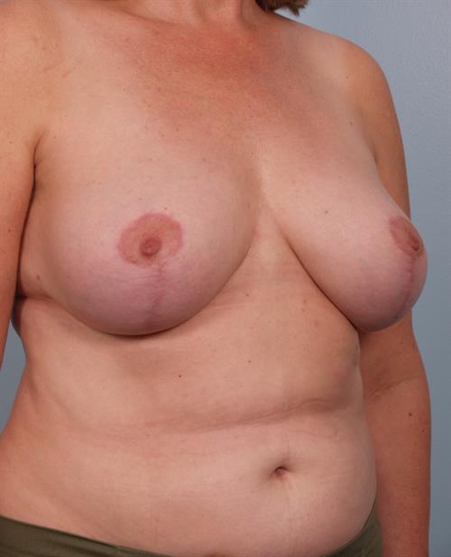 Breast Reduction After Photo | Phoenix and Scottsdale, AZ | Scottsdale Center for Plastic Surgery