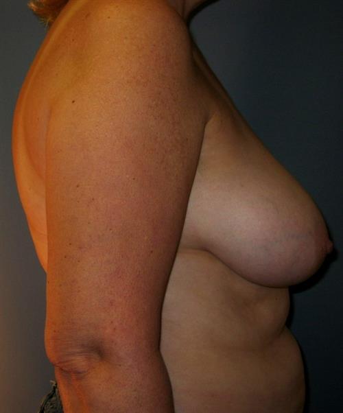 Breast Reduction Before Photo | Phoenix and Scottsdale, AZ | Scottsdale Center for Plastic Surgery