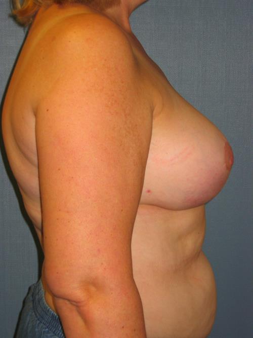 Breast Reduction After Photo | Phoenix and Scottsdale, AZ | Scottsdale Center for Plastic Surgery