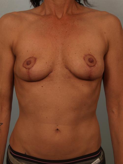 Breast Lift (Mastopexy) After Photo | Phoenix and Scottsdale, AZ | Scottsdale Center for Plastic Surgery
