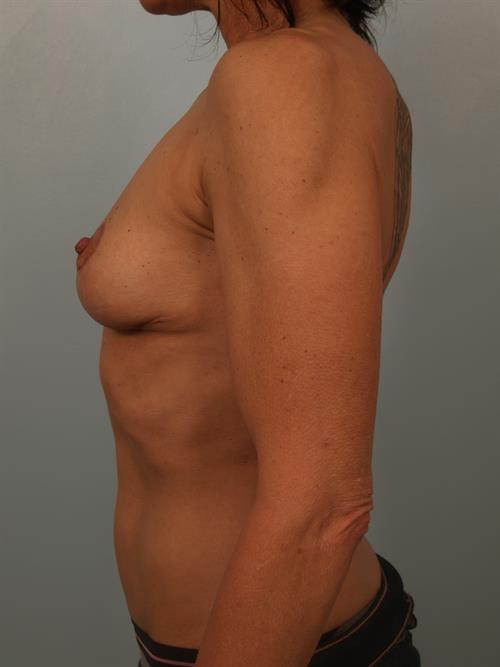Breast Lift (Mastopexy) After Photo | Phoenix and Scottsdale, AZ | Scottsdale Center for Plastic Surgery