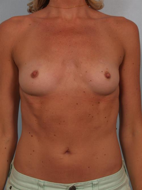 Breast Augmentation Before Photo | Phoenix and Scottsdale, AZ | Scottsdale Center for Plastic Surgery