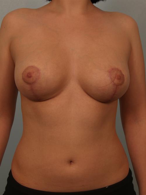 Breast Reduction After Photo | Phoenix and Scottsdale, AZ | Scottsdale Center for Plastic Surgery