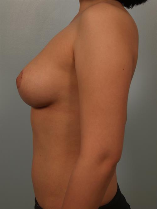Breast Reduction After Photo | Phoenix and Scottsdale, AZ | Scottsdale Center for Plastic Surgery