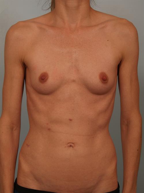 Breast Augmentation Before Photo | Phoenix and Scottsdale, AZ | Scottsdale Center for Plastic Surgery