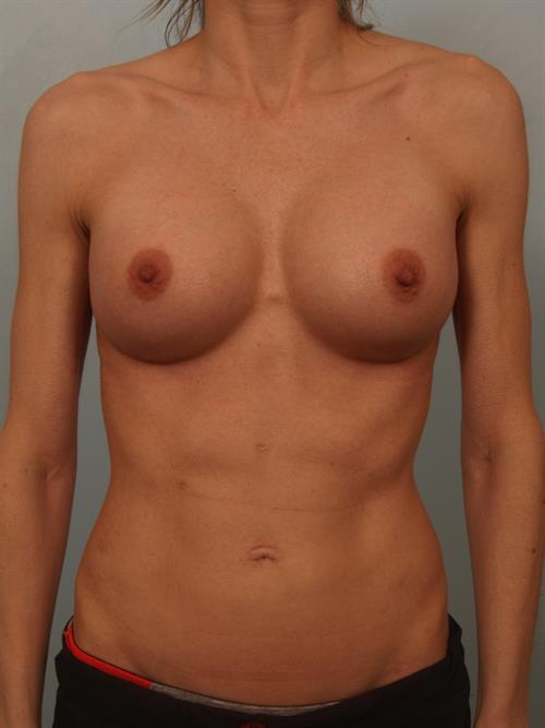 Breast Augmentation After Photo | Phoenix and Scottsdale, AZ | Scottsdale Center for Plastic Surgery
