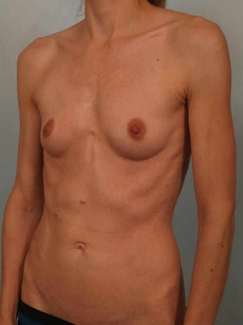 Breast Augmentation Before Photo | Phoenix and Scottsdale, AZ | Scottsdale Center for Plastic Surgery