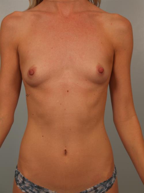Breast Augmentation Before Photo | Phoenix and Scottsdale, AZ | Scottsdale Center for Plastic Surgery