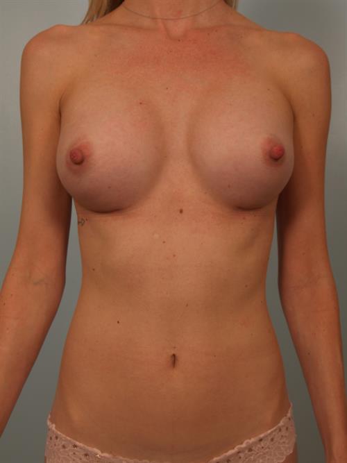 Breast Augmentation After Photo | Phoenix and Scottsdale, AZ | Scottsdale Center for Plastic Surgery
