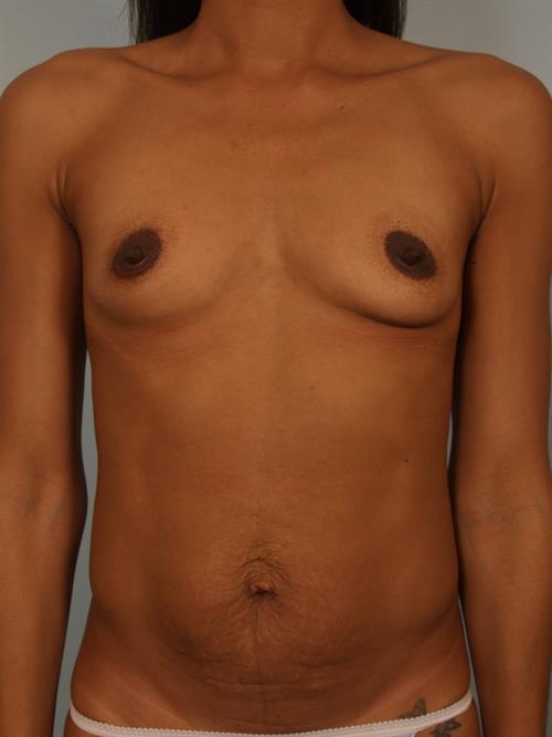 Breast Augmentation Before Photo | Phoenix and Scottsdale, AZ | Scottsdale Center for Plastic Surgery