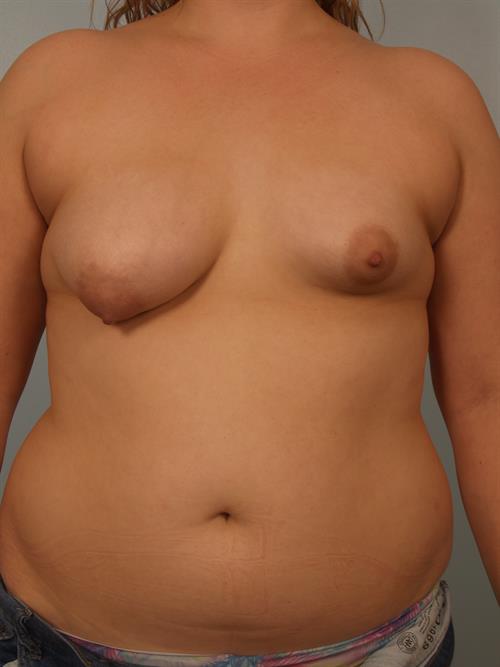 Breast Lift (Mastopexy) Before Photo | Phoenix and Scottsdale, AZ | Scottsdale Center for Plastic Surgery
