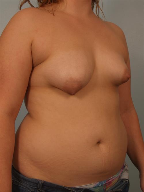 Breast Lift (Mastopexy) Before Photo | Phoenix and Scottsdale, AZ | Scottsdale Center for Plastic Surgery