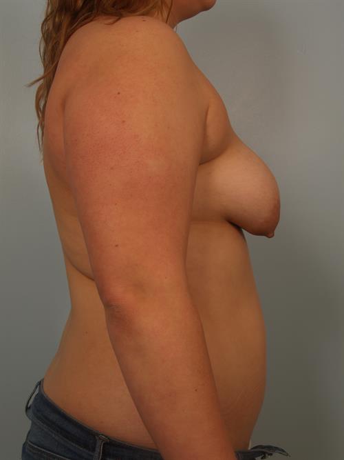 Breast Lift (Mastopexy) Before Photo | Phoenix and Scottsdale, AZ | Scottsdale Center for Plastic Surgery