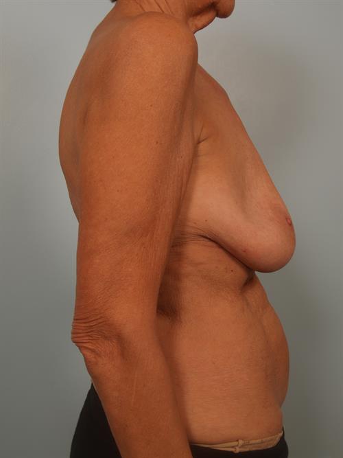 Revision Breast Surgery Before Photo | Phoenix and Scottsdale, AZ | Scottsdale Center for Plastic Surgery